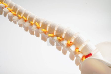 Wirbelsäule und Knochen, Lendenwirbelsäule verschoben Bandscheibenvorfall Fragment, Modell für die Behandlung in der orthopädischen Abteilung.