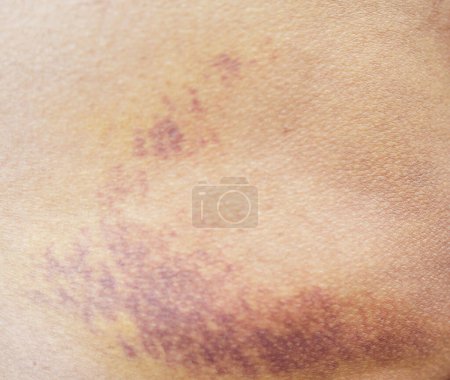 Bruise on the buttock skin injury from accident at home.