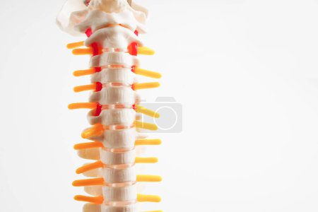 Photo for Spinal nerve and bone, Lumbar spine displaced herniated disc fragment, Model for treatment medical in the orthopedic department. - Royalty Free Image
