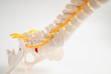 Foto de Nervio espinal y hueso, Fragmento de disco herniado desplazado de la columna lumbar, Modelo para tratamiento médico en el departamento ortopédico - Imagen libre de derechos