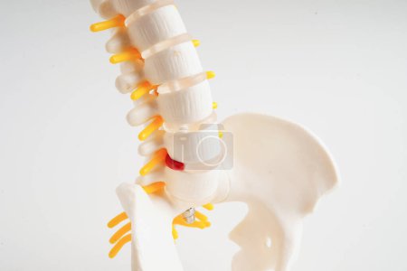 Photo for Spinal nerve and bone, Lumbar spine displaced herniated disc fragment, Model for treatment medical in the orthopedic department. - Royalty Free Image