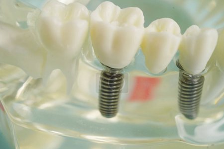 Implants dentaires, racines dentaires artificielles dans la mâchoire, canal radiculaire du traitement dentaire, maladie des gencives, modèle dentaire pour dentiste étudiant la dentisterie.