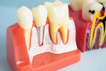 Implants dentaires, racines dentaires artificielles dans la mâchoire, canal radiculaire du traitement dentaire, maladie des gencives, modèle dentaire pour dentiste étudiant la dentisterie.