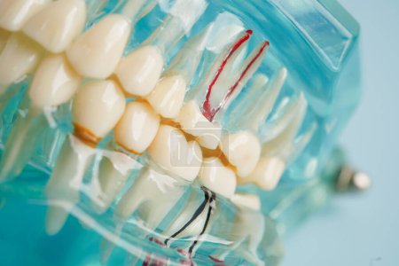 Zahnimplantat, künstliche Zahnwurzeln in den Kiefer, Wurzelkanal der Zahnbehandlung, Zahnfleischerkrankungen, Zahnmodell für Zahnärzte, die Zahnmedizin studieren.