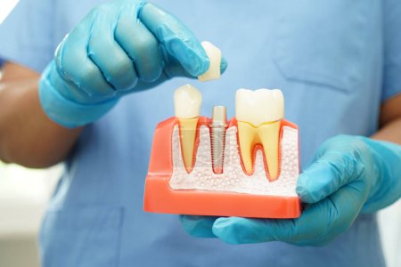 Arzt hält Zahnimplantat, künstliche Zahnwurzeln in den Kiefer, Wurzelkanal der Zahnbehandlung, Zahnfleischerkrankungen, Zahnmodell für Zahnarzt Studium über Zahnmedizin.