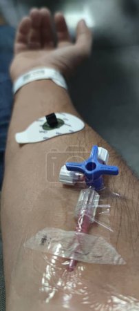 Foto de Image of an arm with blood catheter and devices for electrocardiograms - Imagen libre de derechos