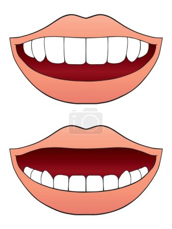 Illustration for Two mouths with missing teeth. One upper and one lower. - Royalty Free Image