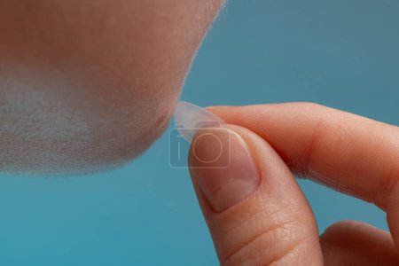Chica con acné palo alrededor de parche de acné en su mejilla. Uso de parches de acné para el tratamiento de la espinilla y la rosácea de cerca. Cosmetología de limpieza del rejuvenecimiento facial