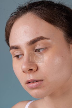 Chica con acné palo alrededor de parche de acné en su mejilla. Uso de parches de acné para el tratamiento de la espinilla y la rosácea de cerca. Cosmetología de limpieza del rejuvenecimiento facial