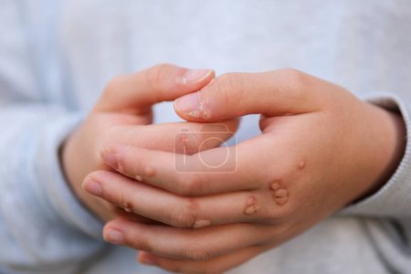 Hand mit Warzenmann Haut Nahaufnahme Hände von jungen Teenager-Mädchen sind mit Warzen übersät eine Menge Papillome Virusinfektion an den Händen berühren Kratzen betrachten Nagel Virusinfektion Wucherungen an den Fingern