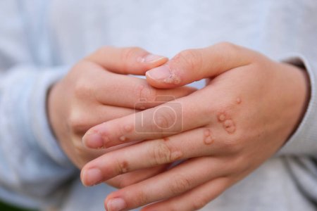 Hand with wart man skin closeup hands of young teenage girl are strewn with warts a lot of papillomas viral infection on hands touch scratching consider near nail viral infection growths on fingers