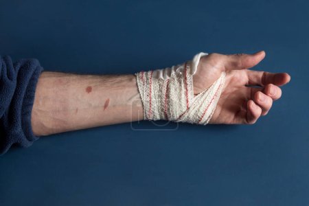Ansicht einer teilweise spiralförmig bandagierten Hand, die auf einem blauen Tisch ruht und die Überreste einer Verbrennung zweiten Grades am Unterarm und die Farbveränderung der Haut zeigt. Erste Hilfe und Wundheilung. 