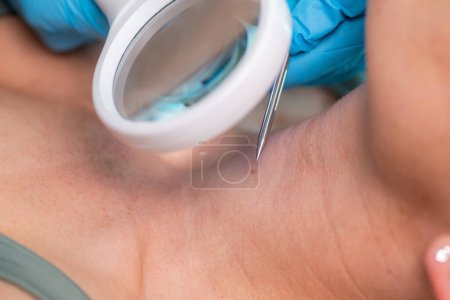 Foto de Dermatólogo utiliza ondas de radio para eliminar las verrugas del cuello de las mujeres para una piel lisa y sin manchas. - Imagen libre de derechos