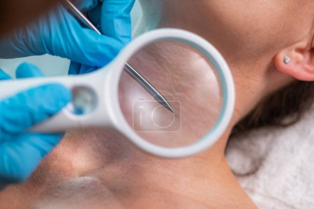 Dermatología tratamiento de las verrugas, la eliminación utilizando el poder de las ondas de radio. Tratamiento de las verrugas y asegurando una piel lisa y sin manchas.  