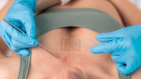 Photo for Dermatologist carefully extracts a skin sample during the procedure aimed at diagnosing and treating various skin conditions. - Royalty Free Image