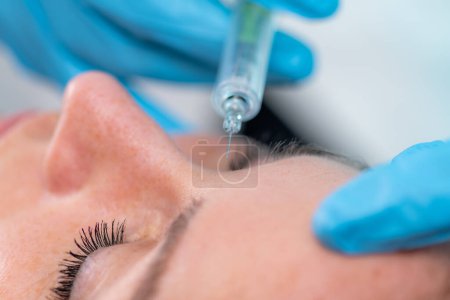 Photo for Treating forehead lines with hyaluronic acid filler, a dermatology treatment that targets forehead wrinkles using hyaluronic acid. - Royalty Free Image