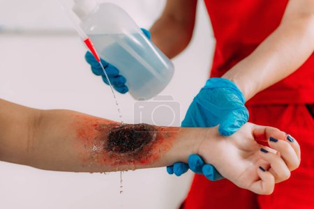 Photo for First aid training  - burn injury. Learning vital first aid for burn injuries. - Royalty Free Image