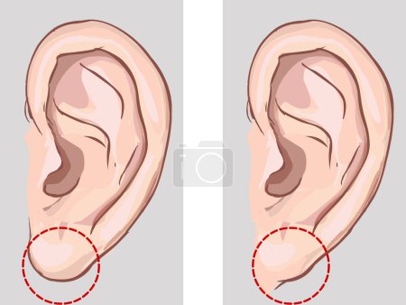 Téléchargez les illustrations : Lobe de l'oreille libre et lobe de l'oreille attaché en comparaison. illustration de stock - en licence libre de droit