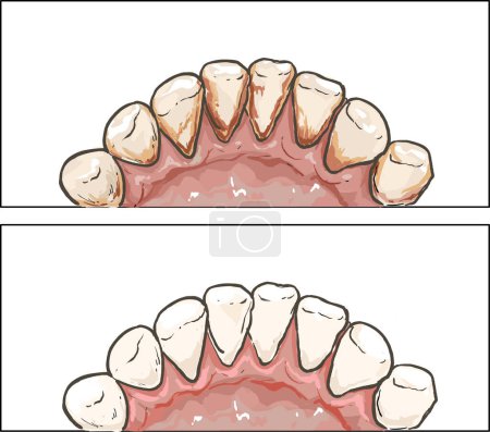 Plaque dentaire cause de maladie parodontale image vectorielle