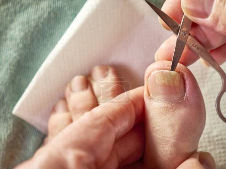 The nail cavity is cleaned with scissors. Treatment of fungal nail diseases.