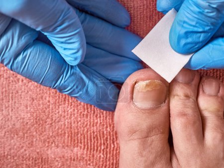 The doctor cleans the cavity of the nail affected by the fungus. Treatment of nail fungus.