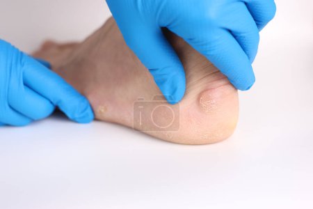 Ein Arzt untersucht Schwielen an den Füßen des Mannes. Behandlung von Hühneraugen an den Füßen.