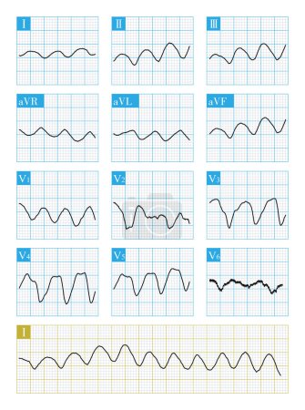 Photo for Ventricular flutter is a fatal fast ventricular arrhythmia. The ECG wave is sine wave, difficult to distinguish QRS wave and T wave, and easy to degenerate into ventricular fibrillation. - Royalty Free Image