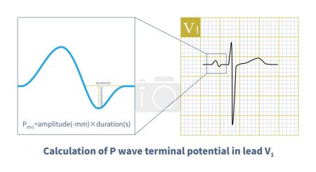 Photo for The negative part of P wave in lead V1 carries the electrical information of the left atrium, and the increase of amplitude and duration indicates that the left atrium is diseased. - Royalty Free Image