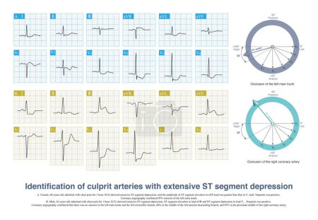Photo for When extensive ST segment depression occurs, the most important differential diagnosis of ECG is to deduce left main artery occlusion or single coronary artery occlusion. - Royalty Free Image