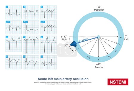 Photo for When extensive ST segment depression occurs, the most important differential diagnosis of ECG is to deduce left main artery occlusion or single coronary artery occlusion. - Royalty Free Image