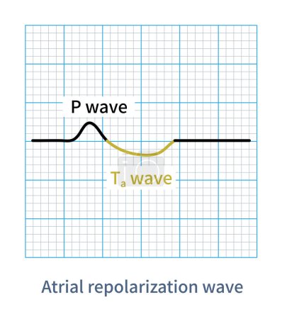Photo for On ECG,   is a low amplitude wave generated by atrial repolarization, and its polarity is opposite to that of P wave in the same lead. - Royalty Free Image