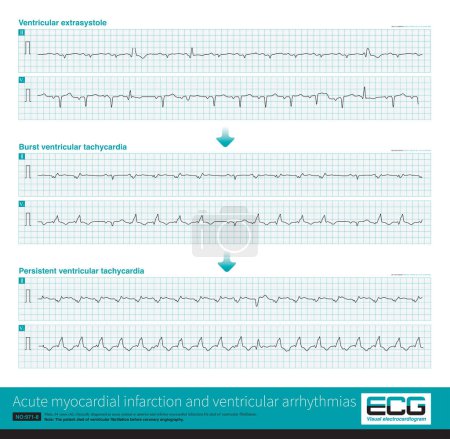 Photo for A patient with acute extensive anterior myocardial infarction developed ventricular arrhythmias during hospitalization. The ventricular arrhythmias worsened and the patient finally died of VF. - Royalty Free Image