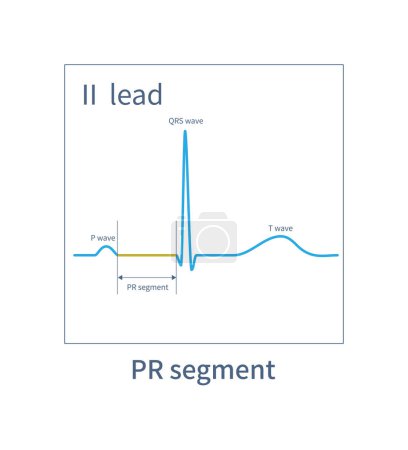 Photo for PR segment is an ECG segment located between the end point of P wave and the start point of QRS wave, usually on the isoelectric line. - Royalty Free Image