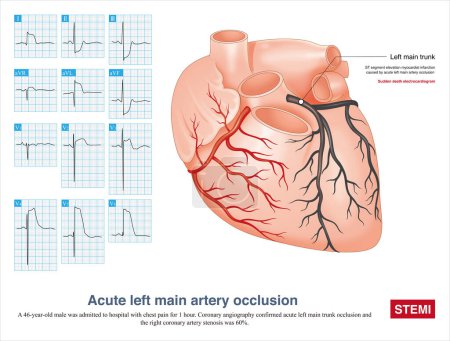 Photo for Acute left main artery occlusion can cause both ST segment elevation and non ST segment elevation myocardial infarction, regardless of which type, the risk of death is high. - Royalty Free Image