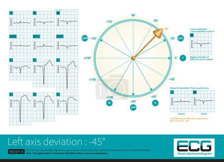 Photo for When AMI causes myocardial necrosis of the posterior inferior wall of LV, the depolarization potential to the right, inferior,and back is lost, and the QRS axis faces the upper left quadrant. - Royalty Free Image