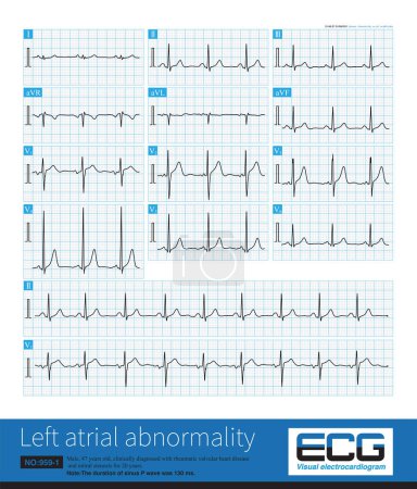 Photo for In clinic, mitral stenosis is a common organic heart disease that leads to left atrium abnormality in ECG. The duration of sinus P wave widens by more than 120ms. - Royalty Free Image