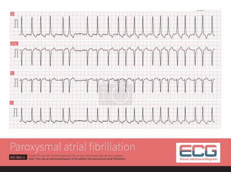 Photo for Tachy-brady syndrome is a special type of  in which bradycardia and tachycardia are repeated alternating episodes.This ECG recorded episodes of paroxysmal atrial fibrillation. - Royalty Free Image