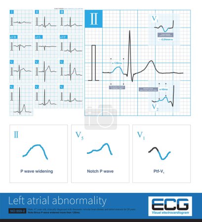 Photo for In clinic, mitral stenosis is a common organic heart disease that leads to left atrium abnormality in ECG. The duration of sinus P wave widens by more than 120ms. - Royalty Free Image