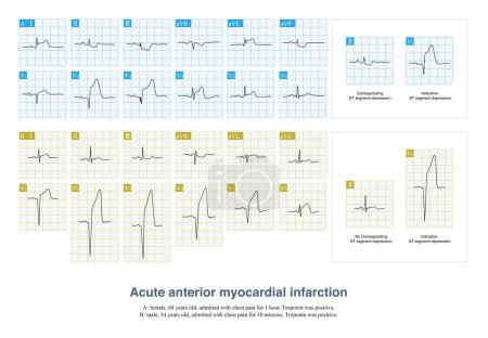 Photo for In some patients with acute anterior myocardial infarction, the inferior leads of the electrocardiogram will have ST segment depression, which is called corresponding ST segment depression. - Royalty Free Image