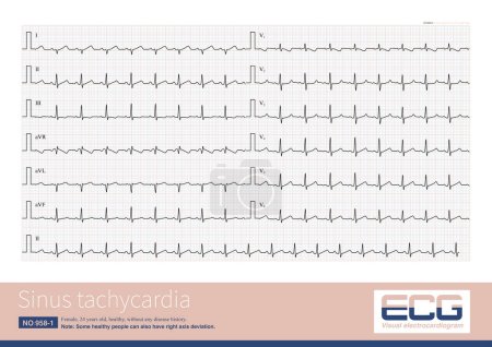 Photo for When the frequency of sinus impulses exceeds 100 beats per minute, called sinus tachycardia, it is a common clinical arrhythmia. Treatment focuses on finding the cause of the increased heart rate. - Royalty Free Image