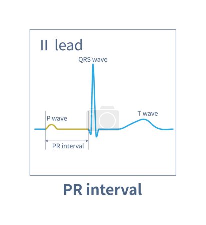 Photo for The PR interval of ECG refers to the time from the starting point of P wave to the starting point of QRS wave, which is the time when the electrical impulse conducts in the conduction system. - Royalty Free Image