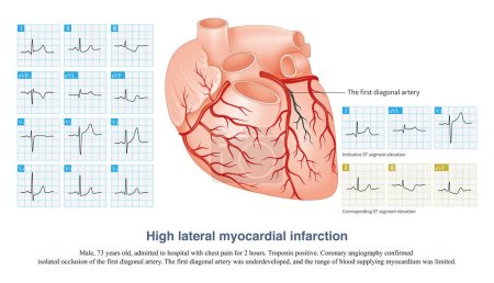 Dans le cas d'un infarctus latéral aigu du myocarde élevé, il y a une élévation indicative du segment ST dans les conduits I et aVL, et une dépression correspondante du segment ST dans les conduits II, III et aVF.