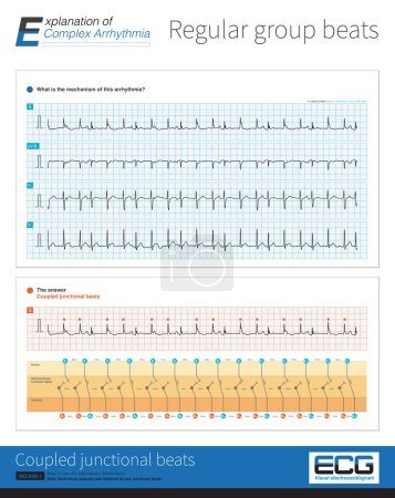 Photo for After each sinus beat, it followed 2 junctional beats, which occurred repeatedly and formed complex arrhythmias. Junctional beats appeared prematurely, in the form of coupled premature beats. - Royalty Free Image