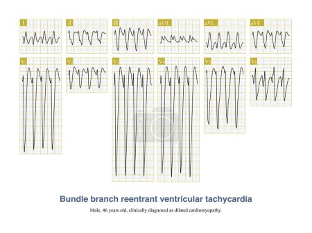Photo for Bundle branch reentrant tachycardia is a life critical ventricular tachycardia that pretends to occur in organic heart disease, with a rapid ventricular rate and a syncope or sudden death attack. - Royalty Free Image