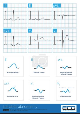 Photo for The ECG changes of left atrium abnormality include widening of P wave duration, bimodal P wave,increasing of P wave terminal potential in lead V1 lead P wave. - Royalty Free Image