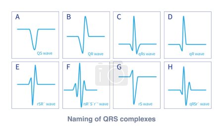 Photo for QRS wave is an electrocardiogram wave formed by ventricular depolarization. According to different waveforms, there are different naming rules. Some of them belong to abnormal QRS waves. - Royalty Free Image