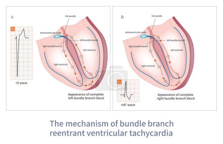 Téléchargez les photos : La réintroduction de la tachycardie ventriculaire réentrante de la branche de faisceau se produit entre la branche de faisceau gauche et la branche de faisceau droite. C'est une tachycardie ventriculaire maligne. - en image libre de droit
