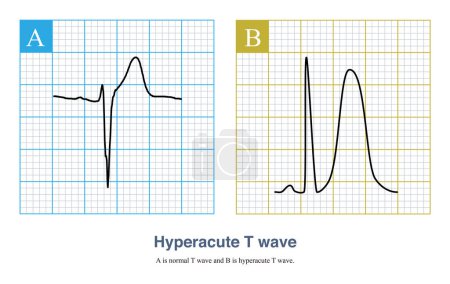 Photo for In the earliest stages of acute myocardial ischemia, the upright T wave amplitude of the ECG increases, and the T wave symmetry increases, called hyperacute T wave. - Royalty Free Image