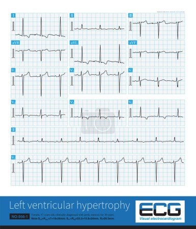 Photo for Sometimes, because the QRS axis is in the upper left quadrant, the high-amplitude R wave of left ventricular hypertrophy occurs in the limb leads, and left chest leads is normal. - Royalty Free Image