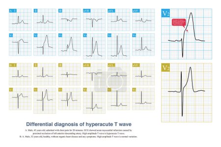 Photo for Hyperacute T waves are characterized by increased T wave symmetry, widening of the base of T waves, higher amplitude, and chest pain in patients. - Royalty Free Image